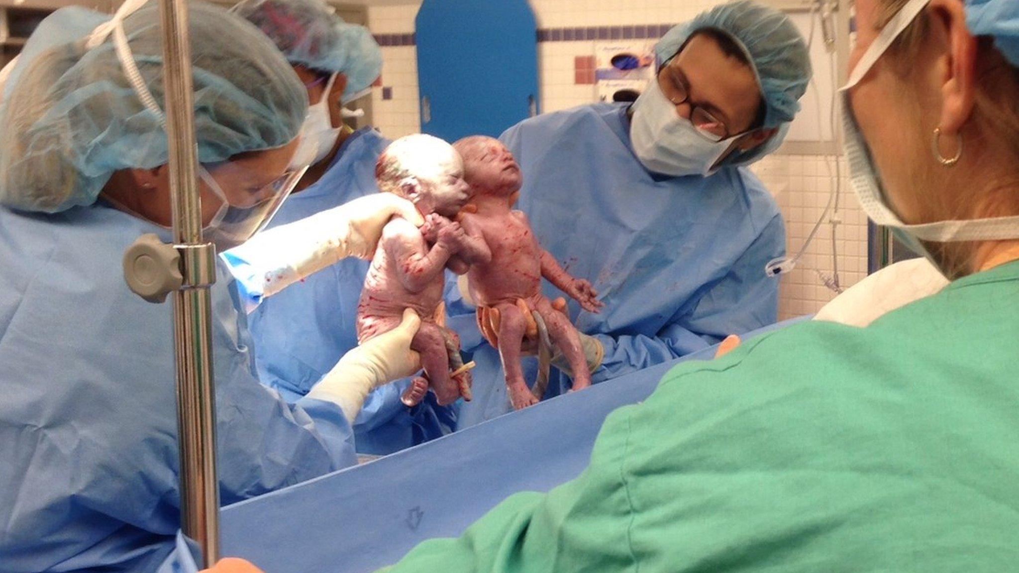 Doctors hold twin girls holding hands shortly after they are delivered