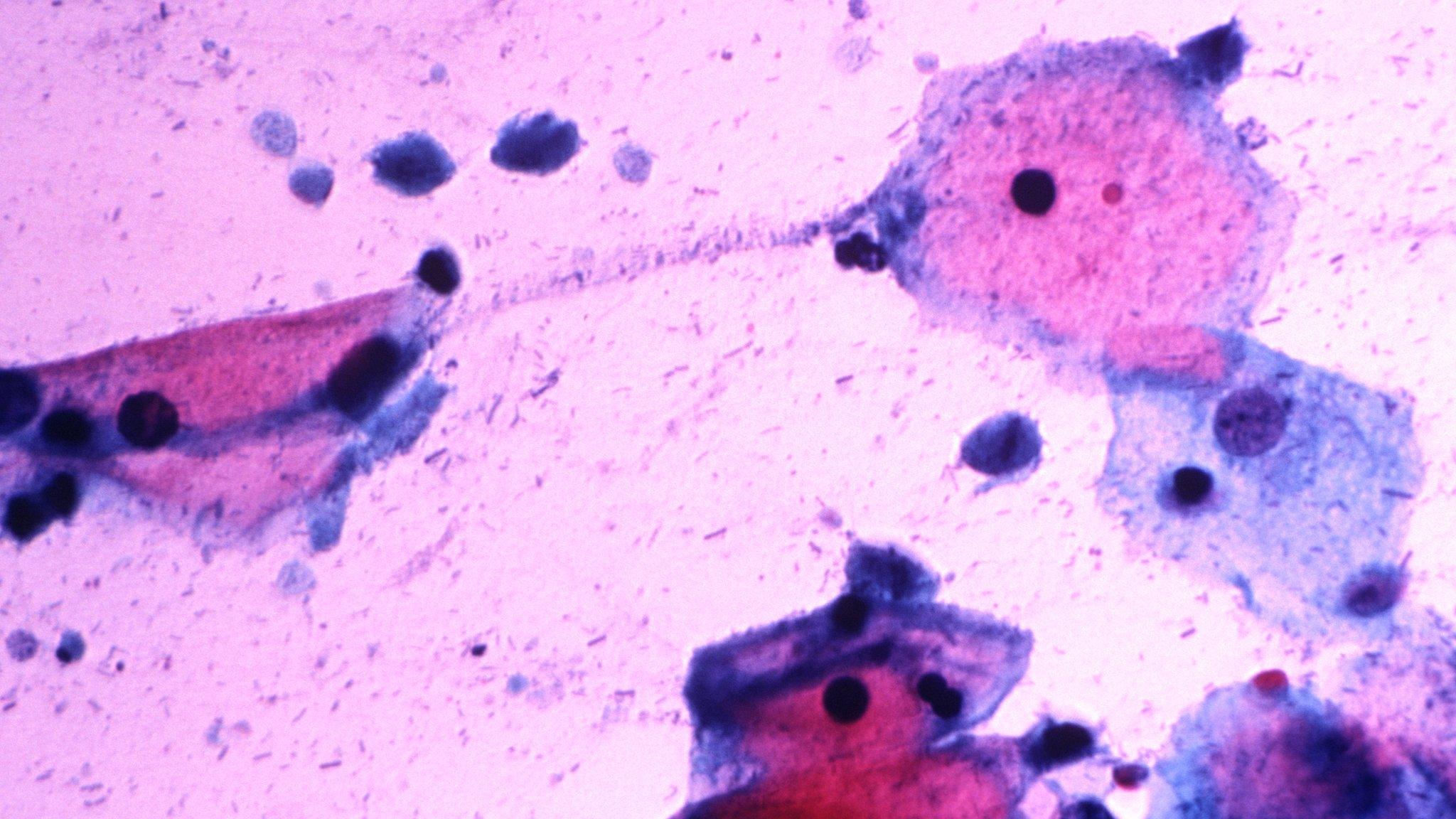 trichomonas vaginalis