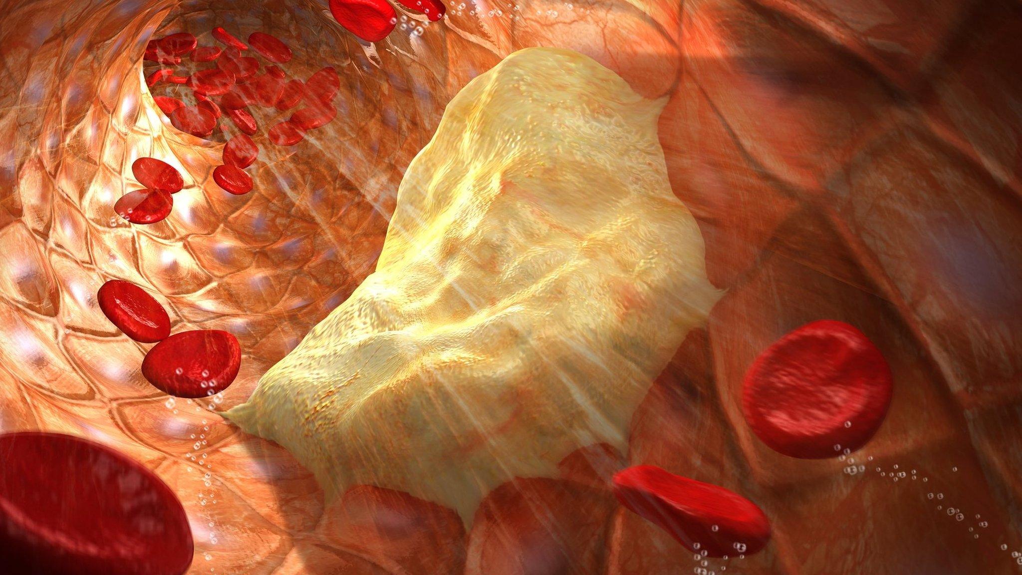 atheroma