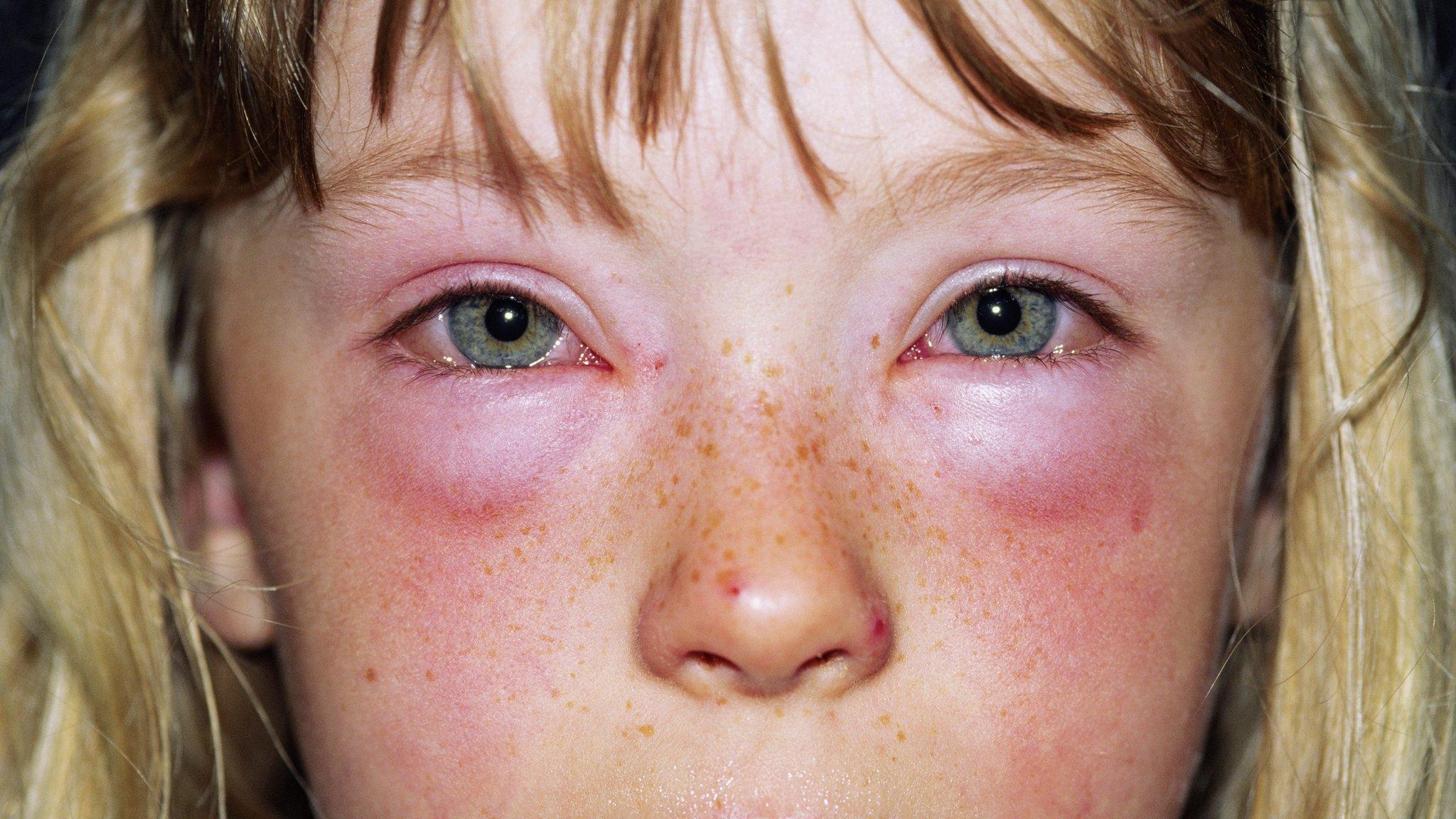 Child with unknown allergy