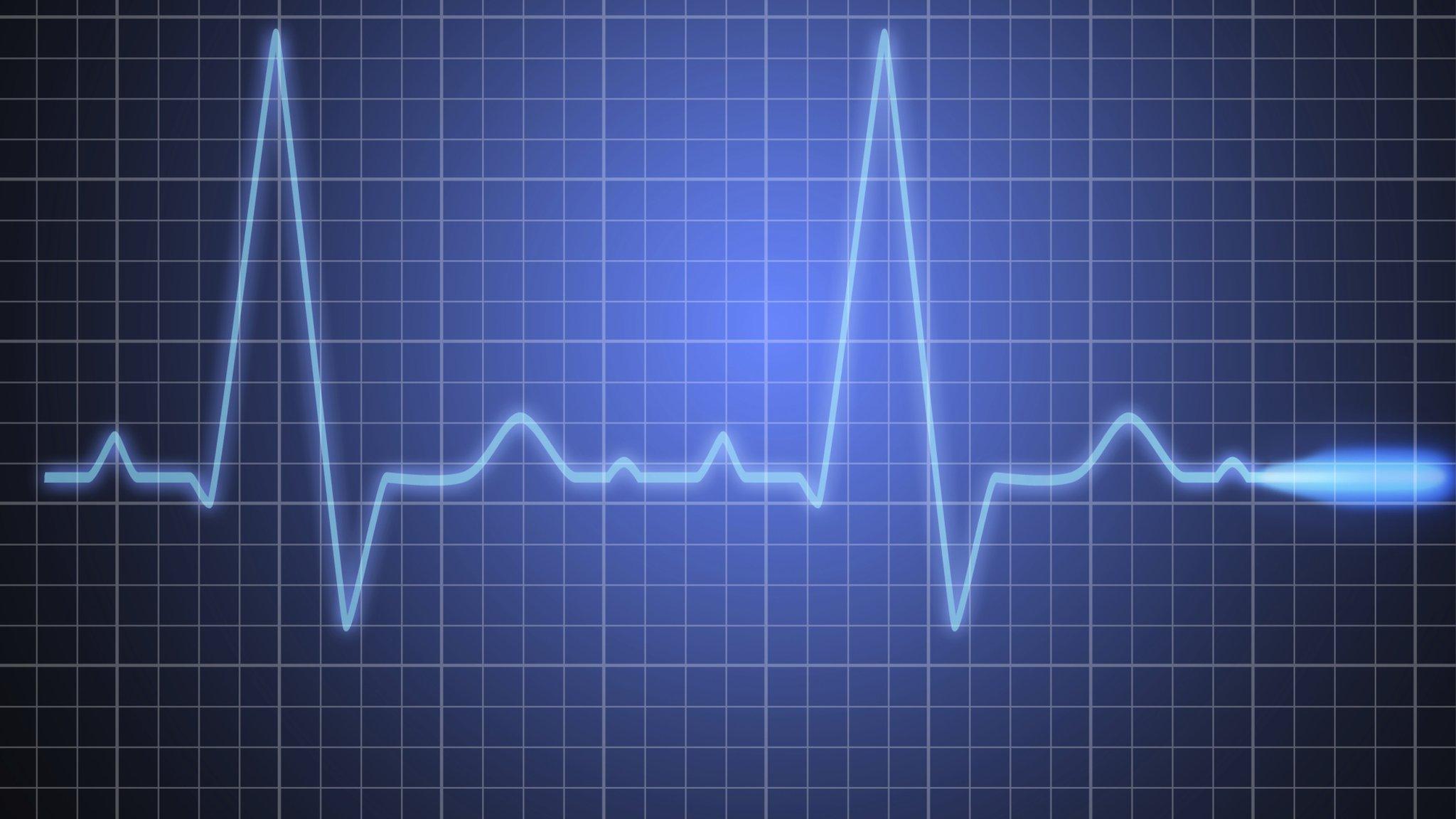 An ECG (electrocardiogram)