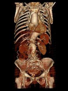 MR Diffusion Tractography