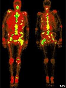 Secondary cancers in the bones