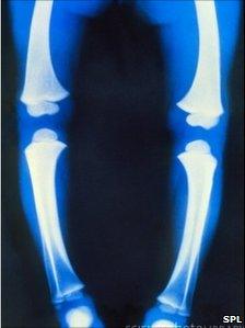 X-ray of a child's leg with rickets