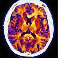 CT scan through the brain of a multiple sclerosis patient