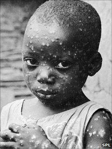 Boy with smallpox