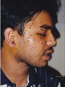 Rais Bhuiyan after the attack