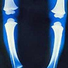 Coloured X-Ray of the legs of a child with rickets