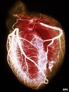 Arteriogram of arteries of healthy heart