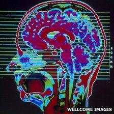 MRI scan of a head showing the brain