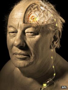 Deep Brain Stimulation