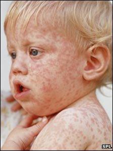 Boy with measles