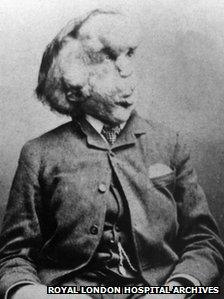 Joseph Merrick