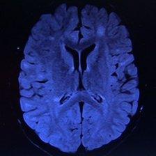 A scan of Emily's brain