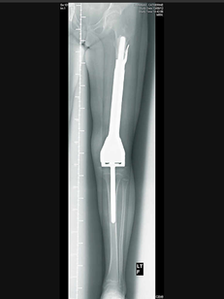 Leg X-ray