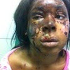 Naomi Oni after acid attack