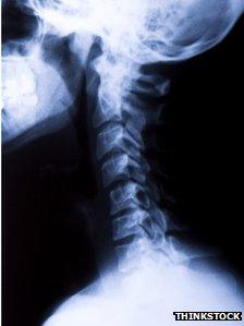 x-ray of neck