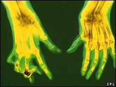 An X-ray of hands affected by rheumatoid arthritis