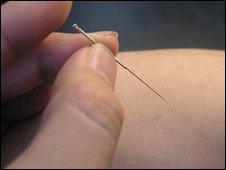 Acupuncture needle