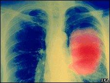 Lung cancer