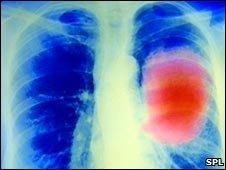 Lung cancer