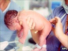 A baby born by Caesarean