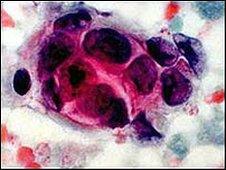 Image of breast cancer