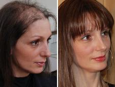 Hair loss - before and after