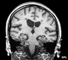 MRI scan of a brain with multiple sclerosis