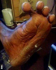 Junior's foot causes him considerable pain