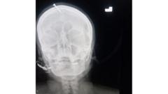 An x-ray of the nail stuck through the woman's head