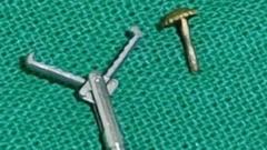 Surgery for Indian woman who inhaled nose pin
