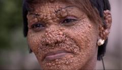 'Àwọn èèyàn ma n sá, wọ́n sì má n bẹ̀rù ẹbí mi nítorí Trichoepithelioma tó mú wa'