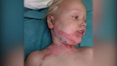 Mum of girl burned by firework warns of dangers