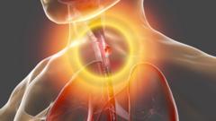 cáncer de esófago