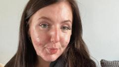 Acne fighter films her skin journey to help others