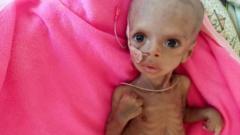 Surafeal Mearig is among the many children who are suffering because of the conflict