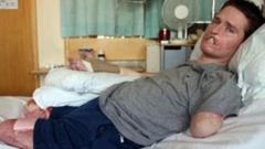 The quadruple amputee who needs the correct prosthetic - BBC News