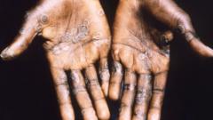 Des pustules caractéristiques de la variole du singe sur la paumea des mains d'un patient en République démocratique du Congo.