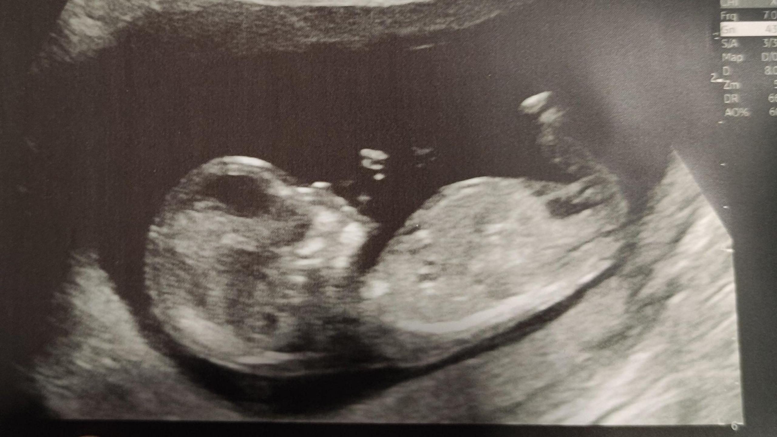 An ultrasound of a baby. 