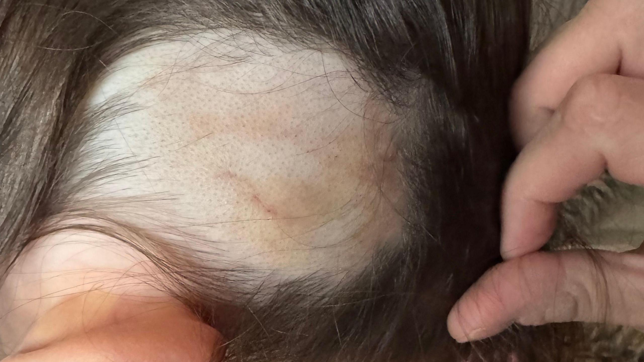 A three-year-old girl sits on a grey seat, revealing a 10cm square bald patch on her scalp, surrounded by her natural brown hair. The skin is bruised and red.