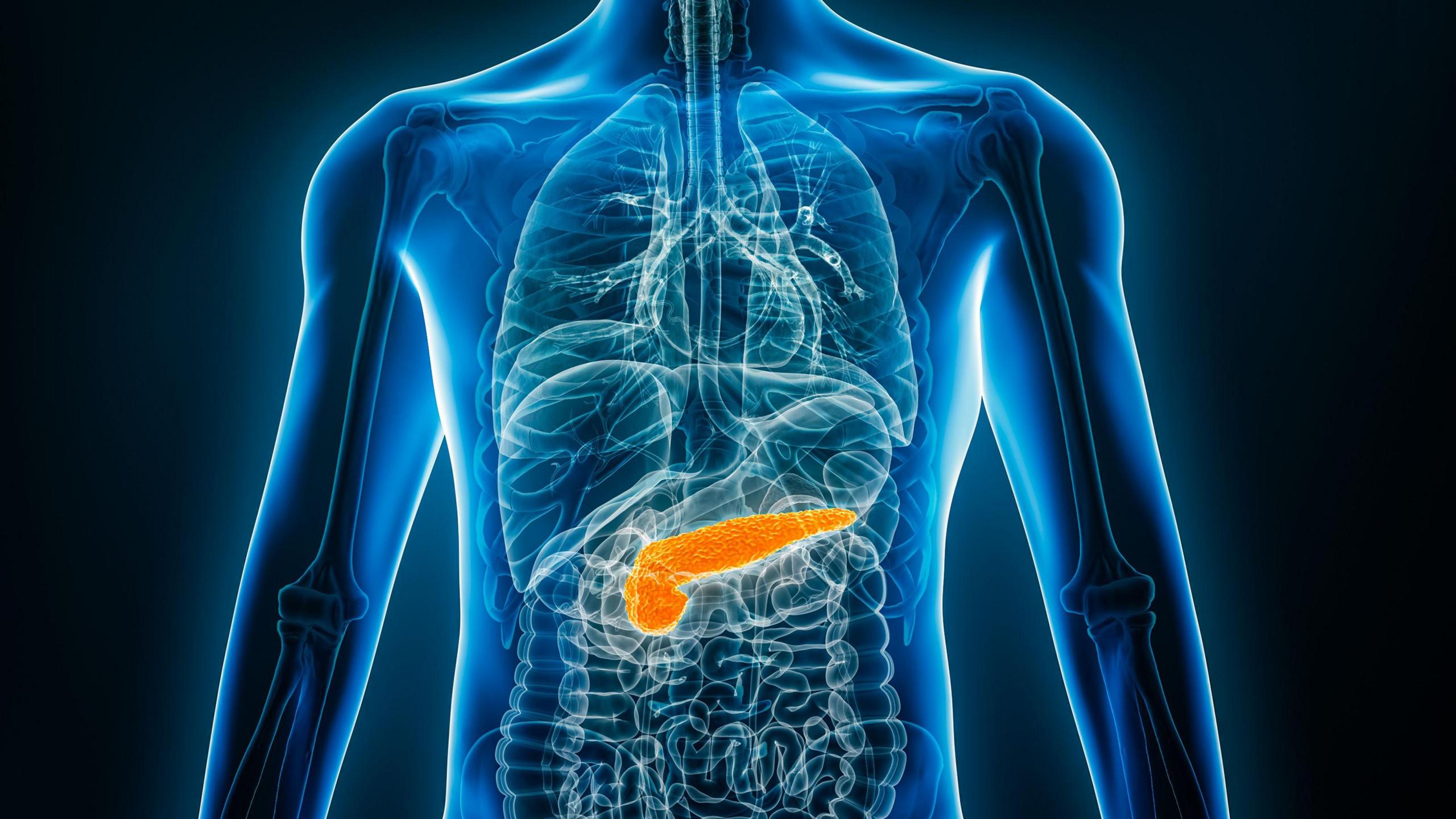 Dealbh x-ray de chom neach leis a' bhrisgean-mhilis air a chomharrachadh le dath oirains