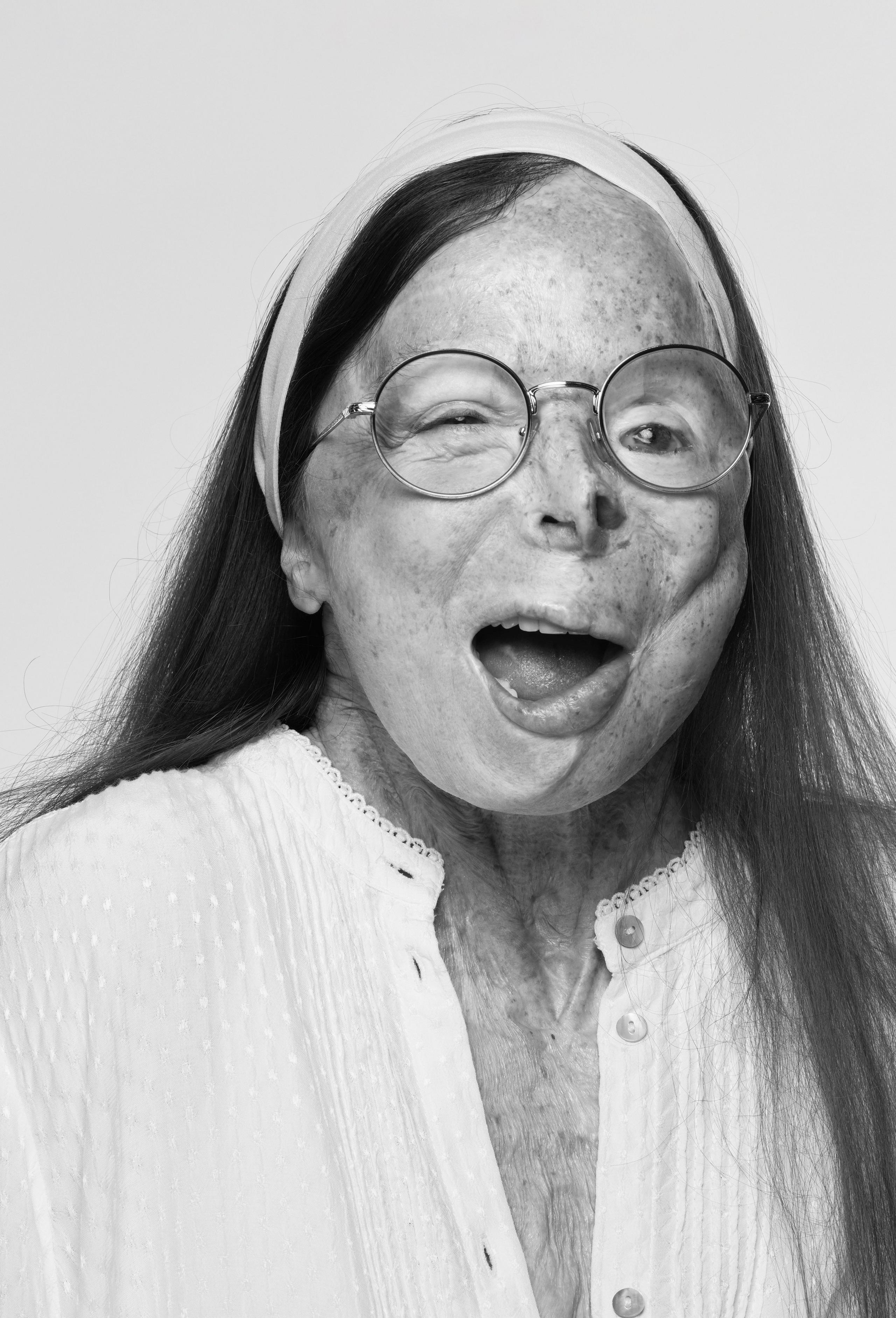 Belgian acid attack survivor and activist Patricia Lefranc