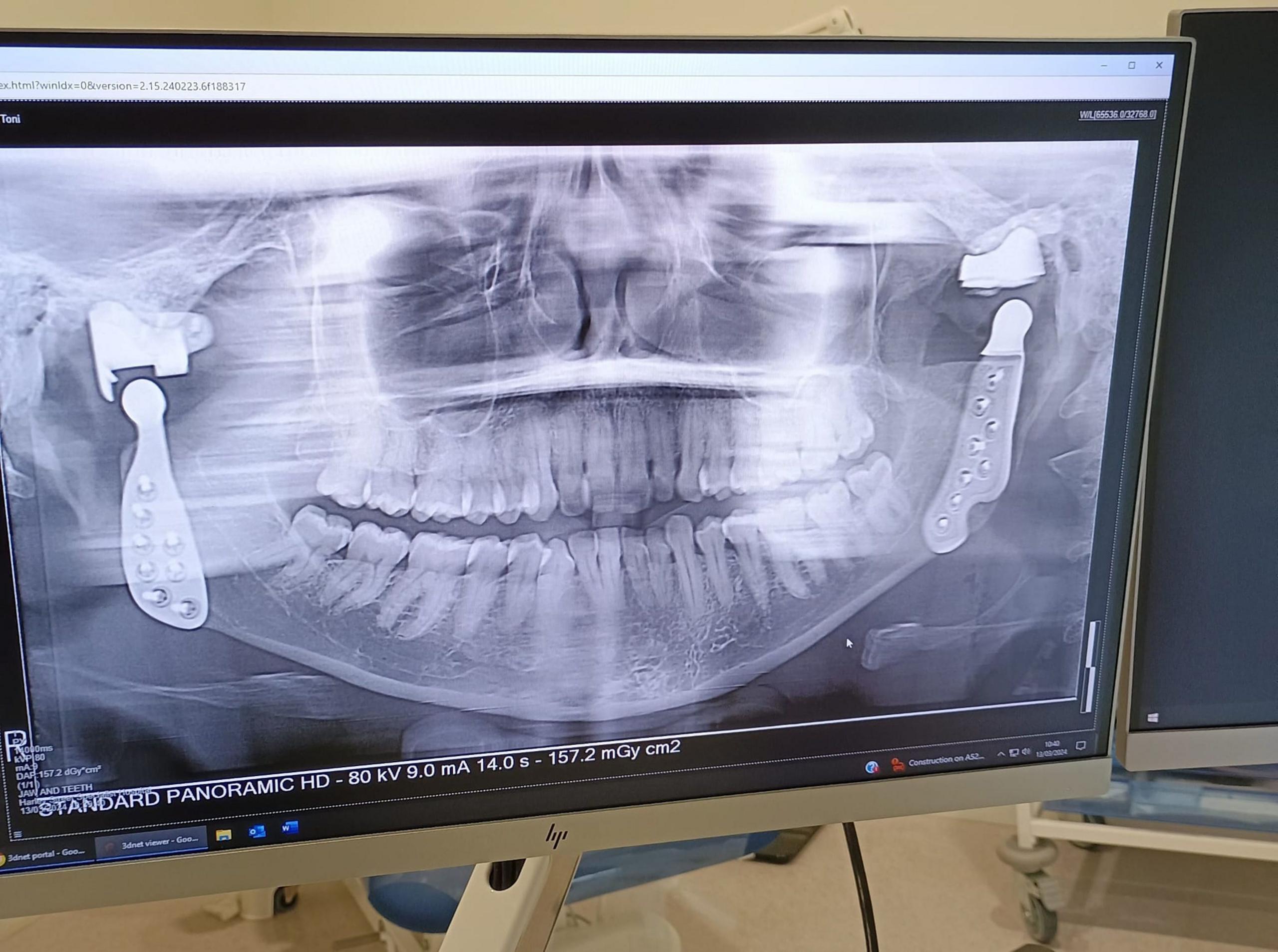 An x-ray image on a computer screen showing Toni Bull's skull with two titanium joins implanted