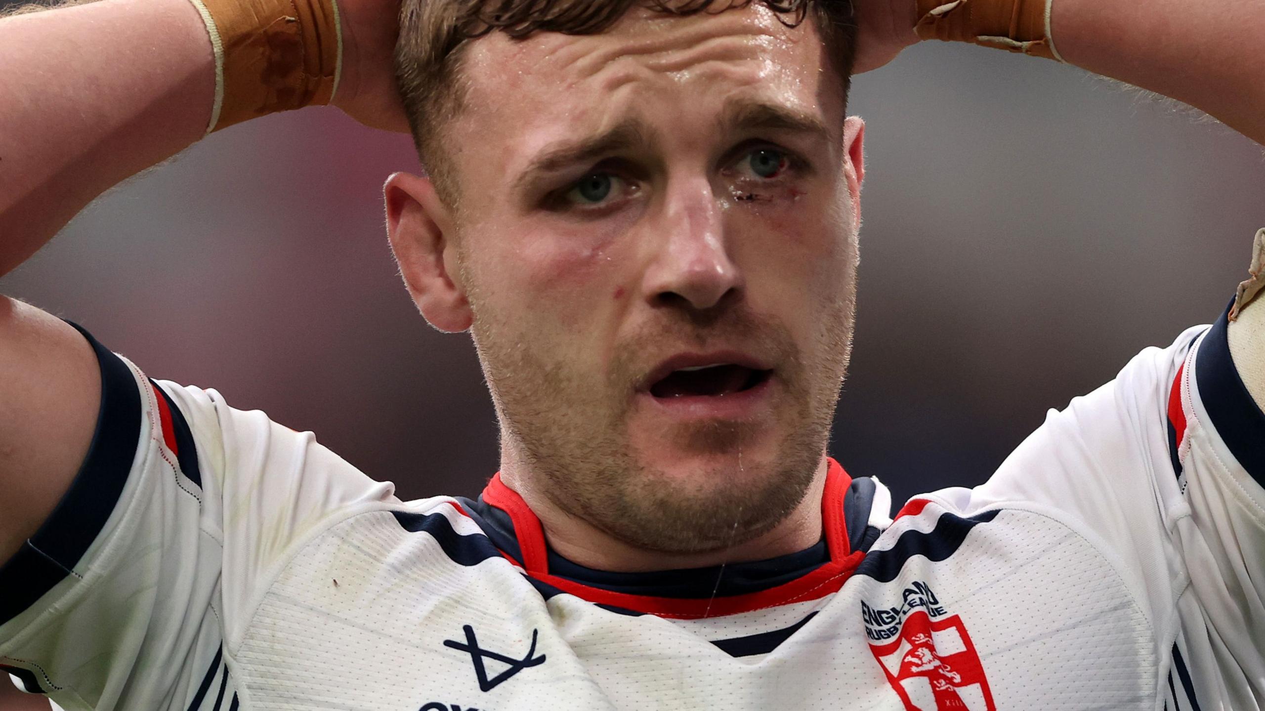 Matty Lees pictured in close up with scarring around his eye