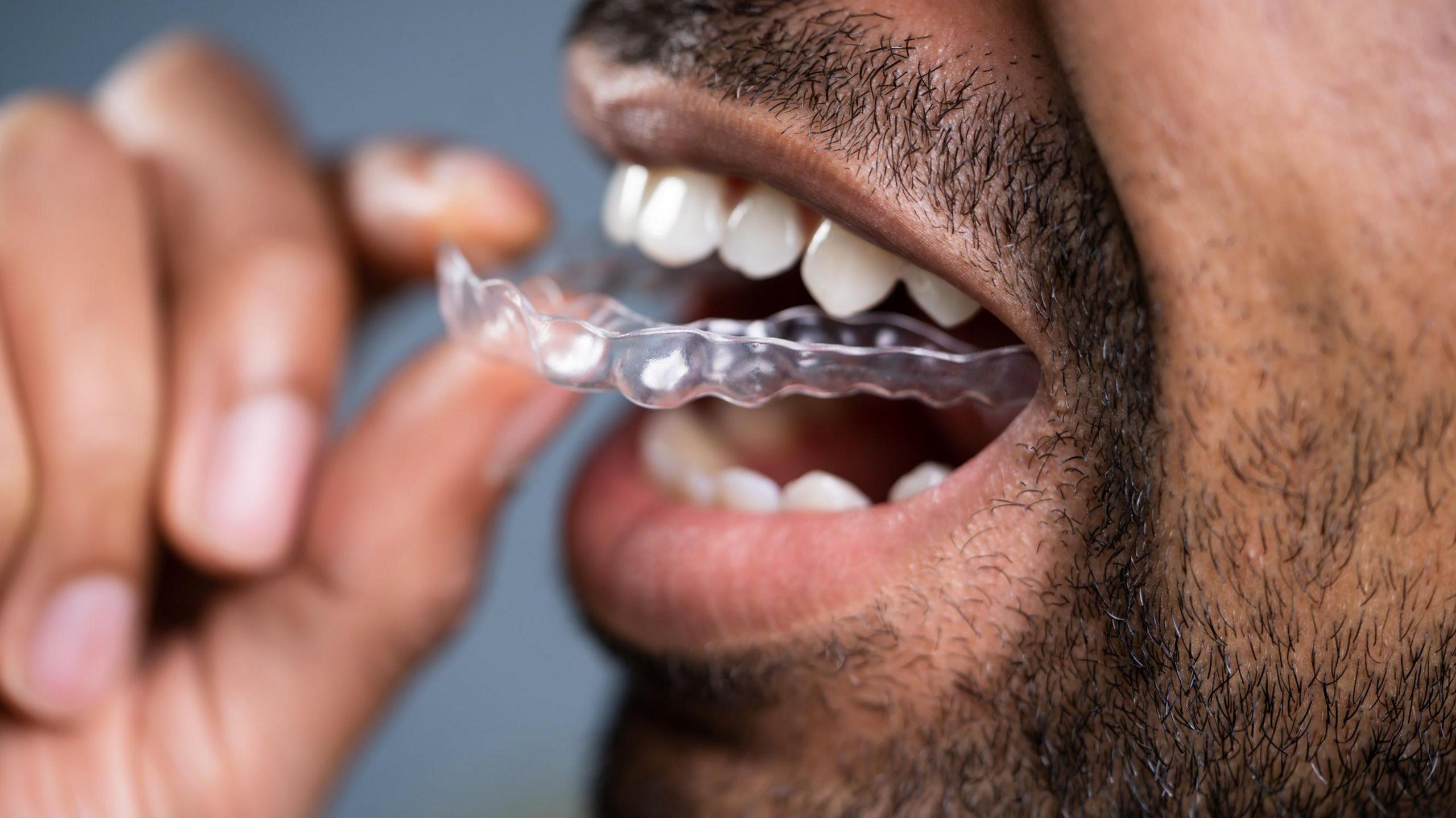 A bearded man places a transparent mouth guard onto his teeth