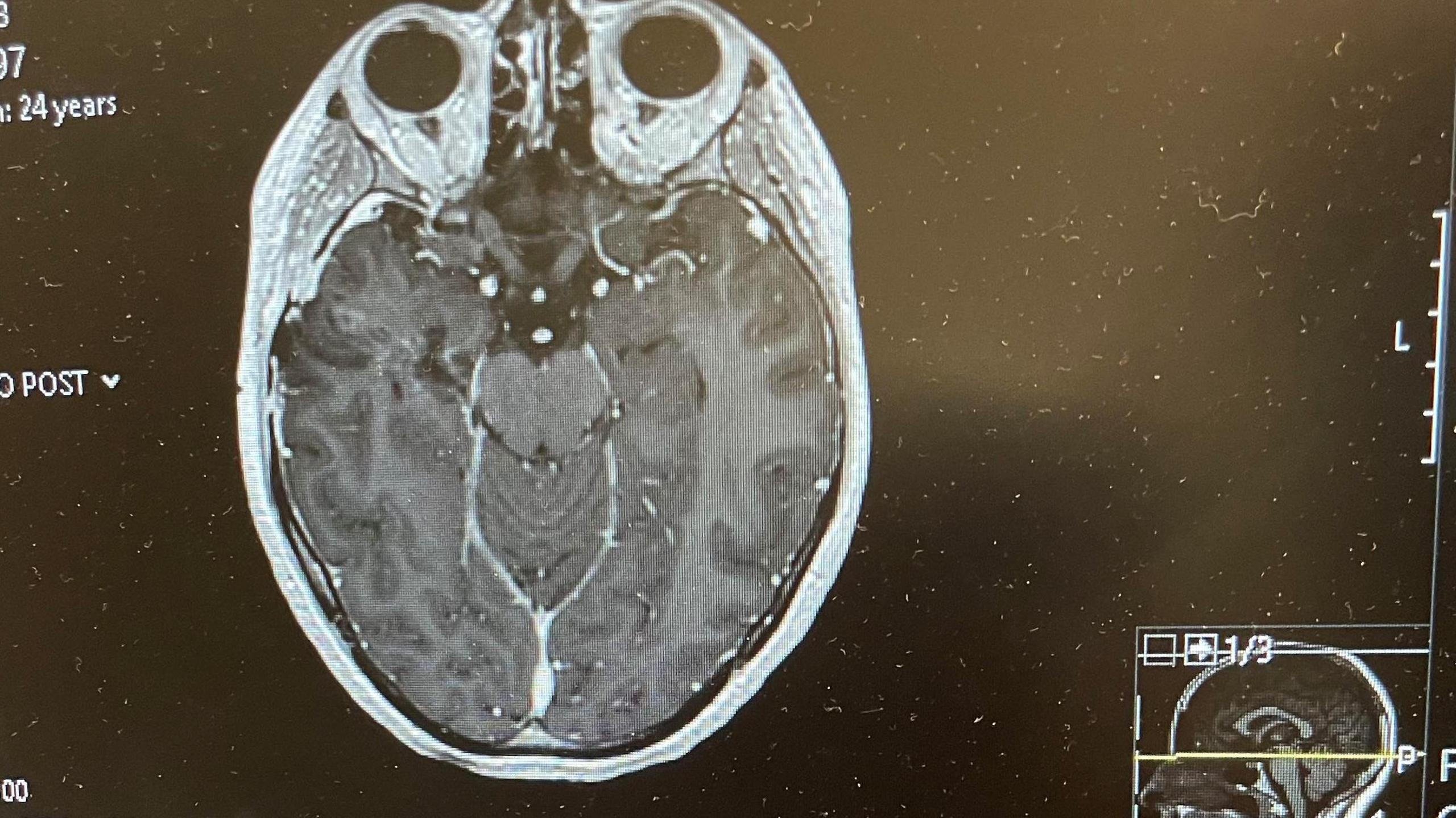 One of Jesse's brain scans is seen on a black screen detailing the progress of her tumour.