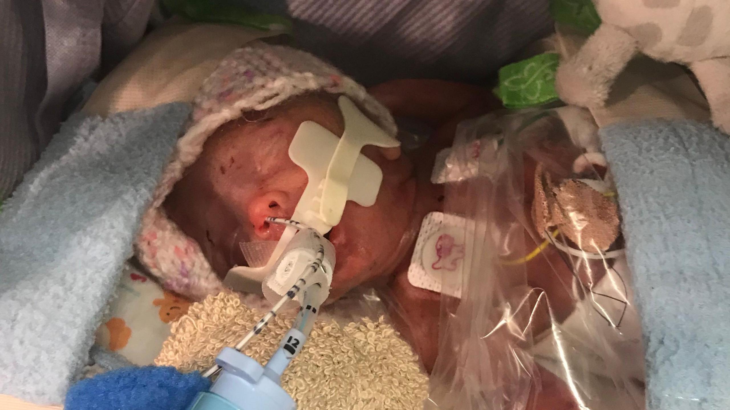 Isla lying in a hospital bed. She is wearing a knitted hat and covered in blankets and a plastic sheet. She is being tube fed and is very small, having been born so prematurely.