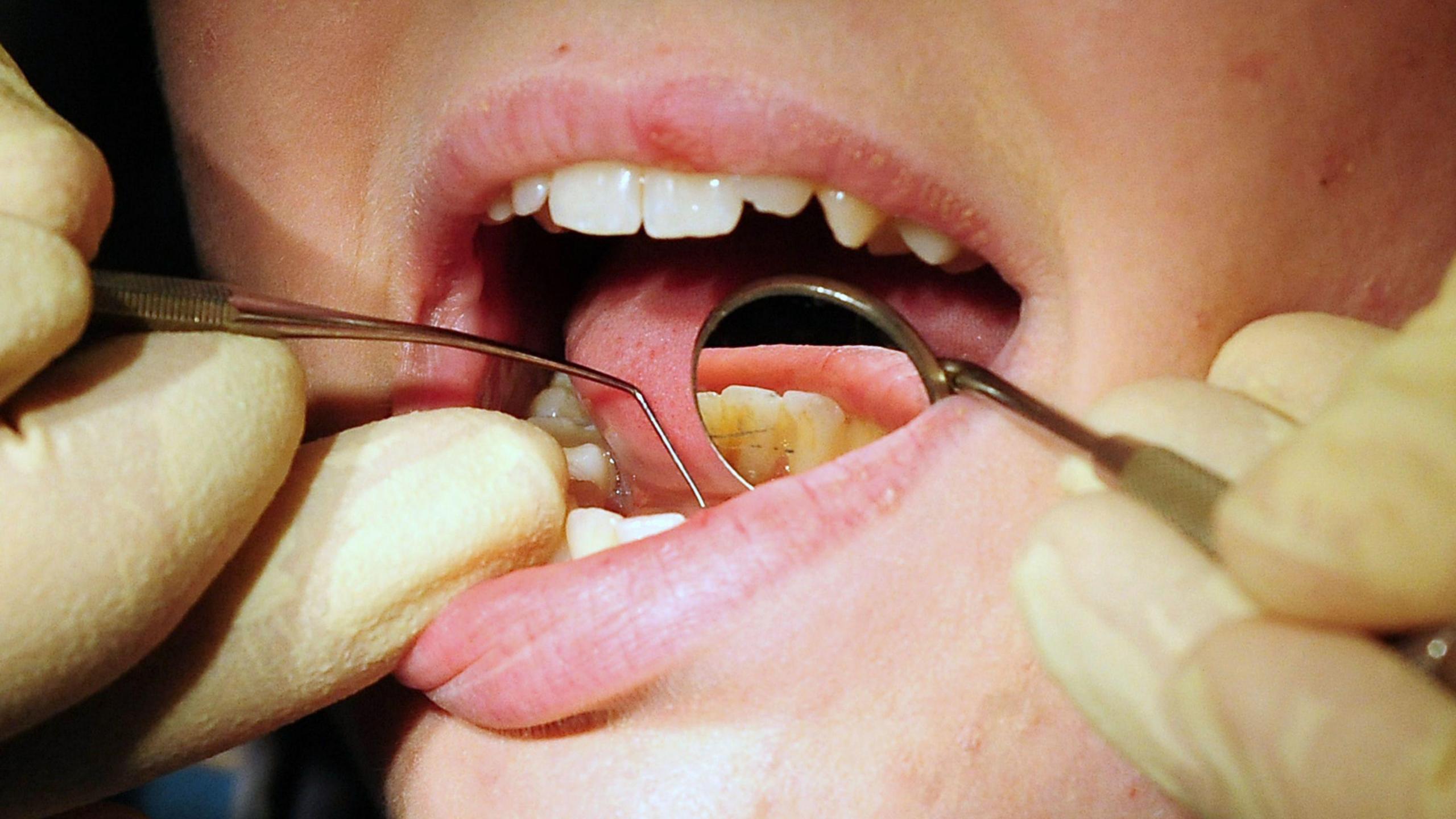 A close-up image of a person's teeth being worked on by a dentist. The patient's mouth is open and two hands, in latex gloves, hold a dental mirror and a dental pick.