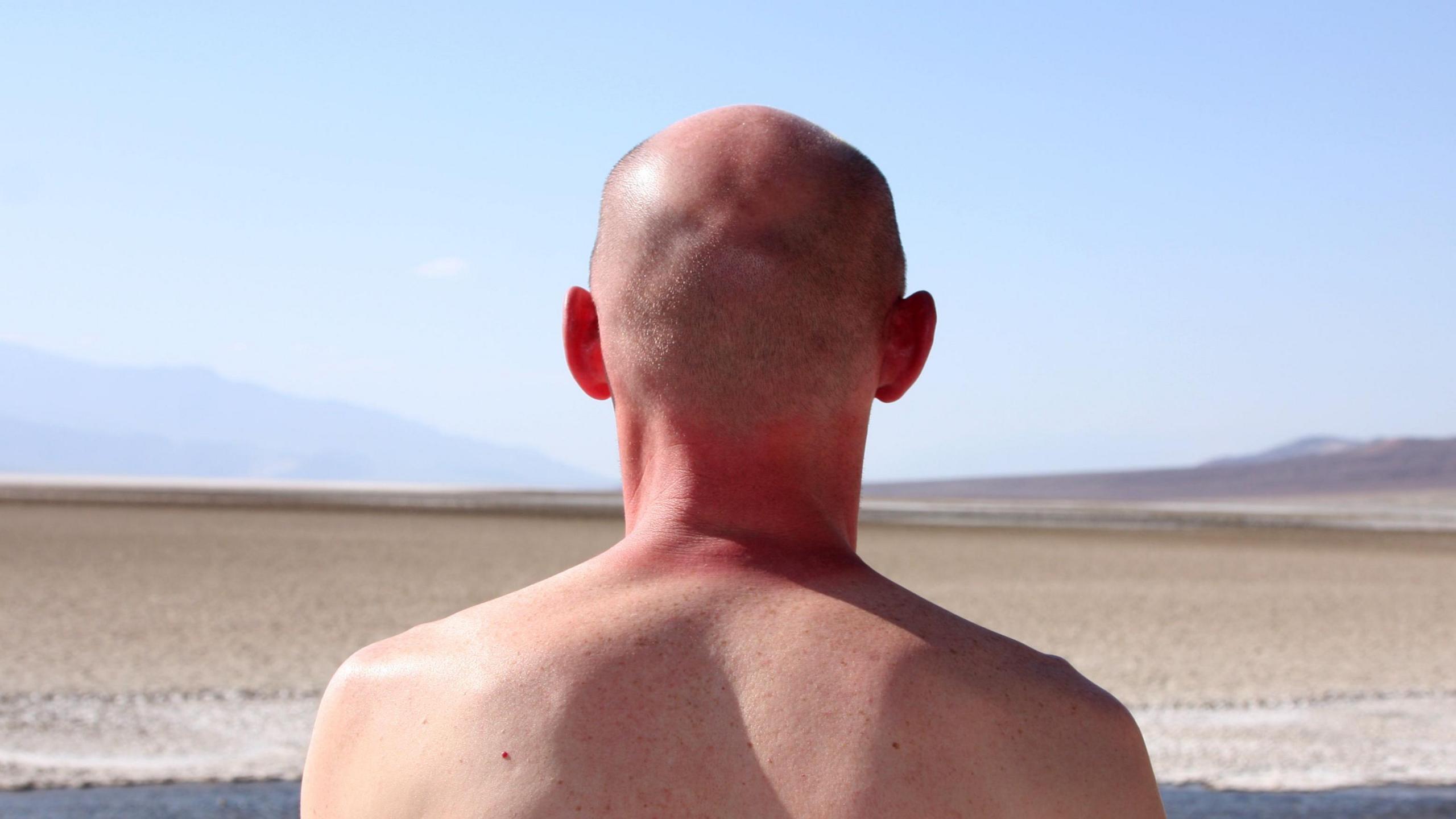 A topless man starting to burn in the strong Sun